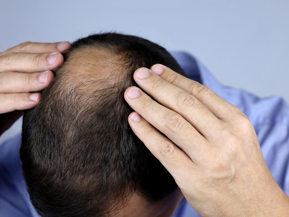 simple-home-remedies-to-help-manage-alopecia-areata-spot-baldness-naturally 6 Simple Home Remedies to Help Manage Alopecia Areata (Spot Baldness) - Photo Gallery
