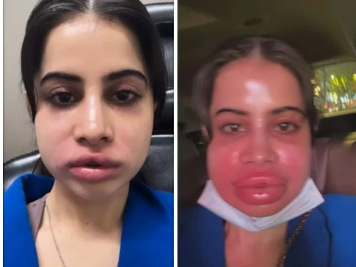 urfi-javed-lip-filler-gone-wrong-heres-the-full-story-from-under-eye-fillers-to-dissolution Urfi Javed Lip Filler Gone Wrong? Here’s The Full Story - Photo Gallery