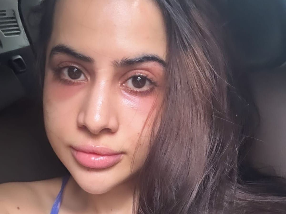 urfi-javed-lip-filler-gone-wrong-heres-the-full-story-from-under-eye-fillers-to-dissolution Urfi Javed Lip Filler Gone Wrong? Here’s The Full Story - Photo Gallery