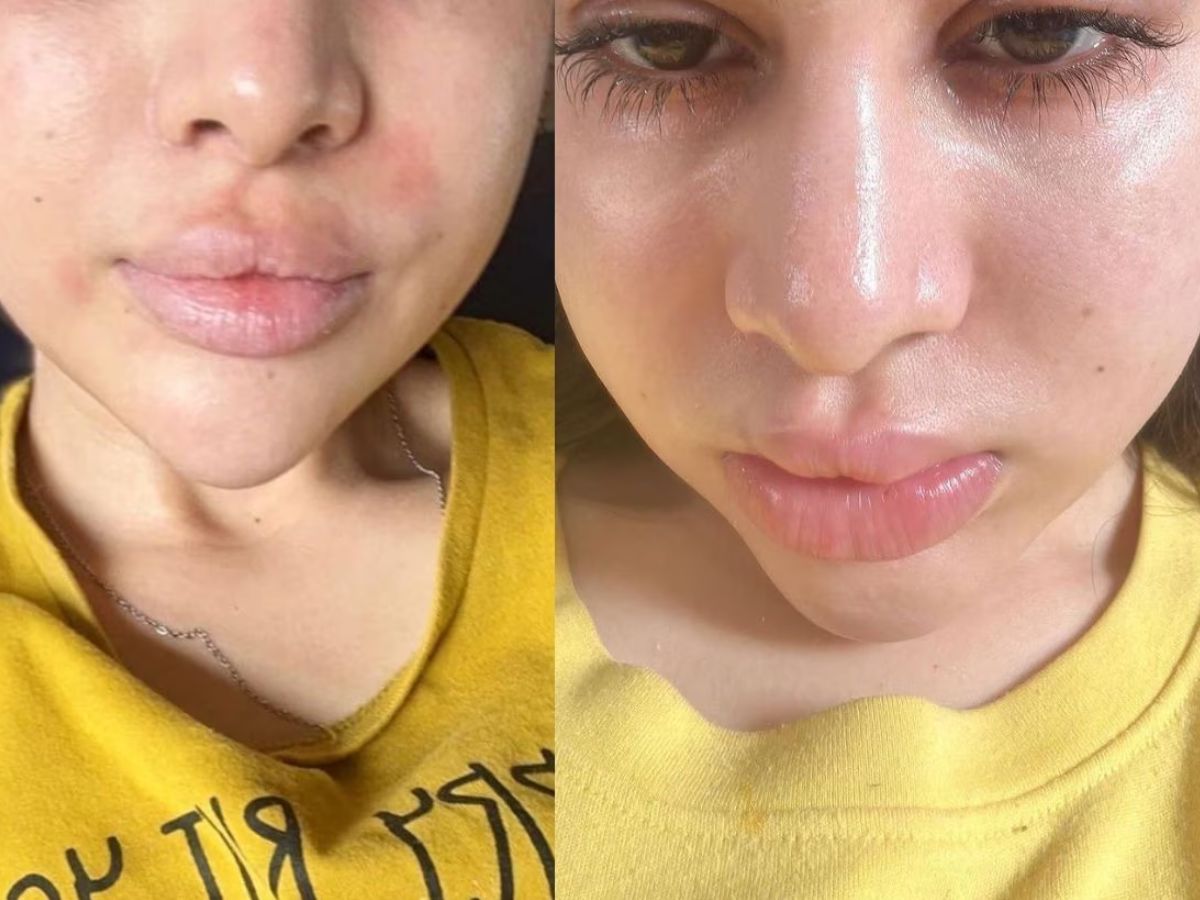 urfi-javed-lip-filler-gone-wrong-heres-the-full-story-from-under-eye-fillers-to-dissolution Urfi Javed Lip Filler Gone Wrong? Here’s The Full Story - Photo Gallery