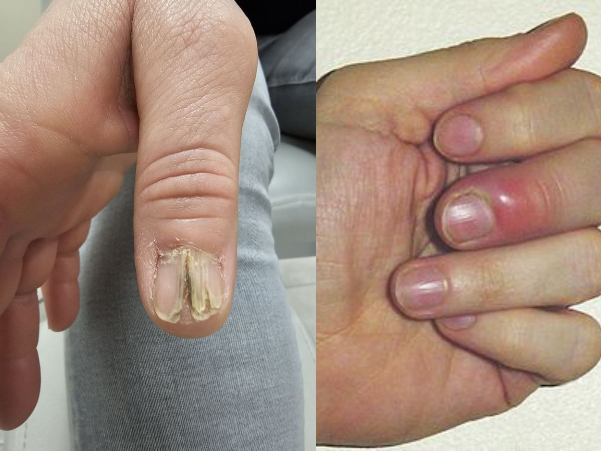Secretly This Habit Is Harming Your Body!! 8 Health Problems Caused By Eating Nails - Photo Gallery