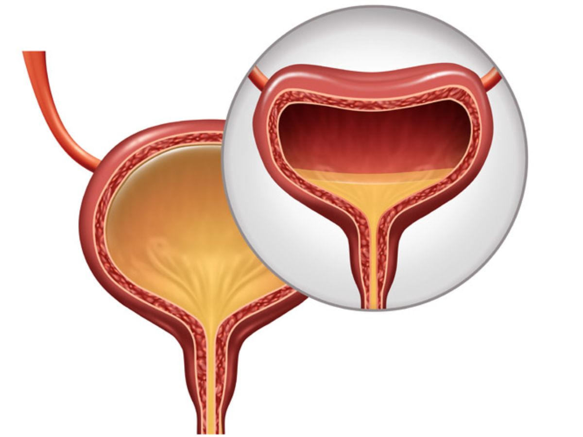 overactive-bladder-5-lifestyle-changes-that-work-for-control-and-relief Overactive Bladder? 5 Lifestyle Changes That Really Work for Better Control and Relief - Photo Gallery