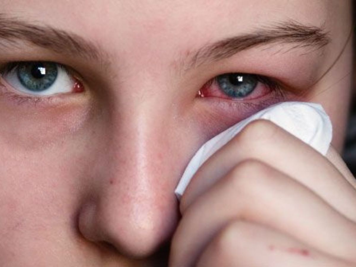 in-pics-from-dengue-to-skin-allergies-here-are-infections-and-allergies-that-spread-in-monsoon-season Conjunctivitis is common in the monsoon due to the wet and humid weather (Image Credit- Pinterest) - Photo Gallery