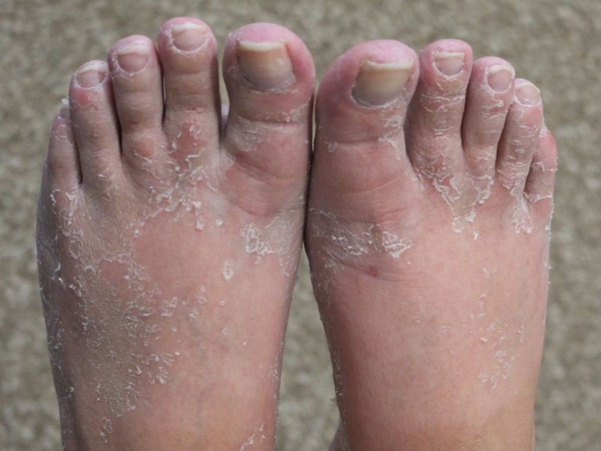 in-pics-from-dengue-to-skin-allergies-here-are-infections-and-allergies-that-spread-in-monsoon-season Fungal infections occur in the monsoon because the wet weather helps germs grow on the skin (Image Credit- Pinterest) - Photo Gallery