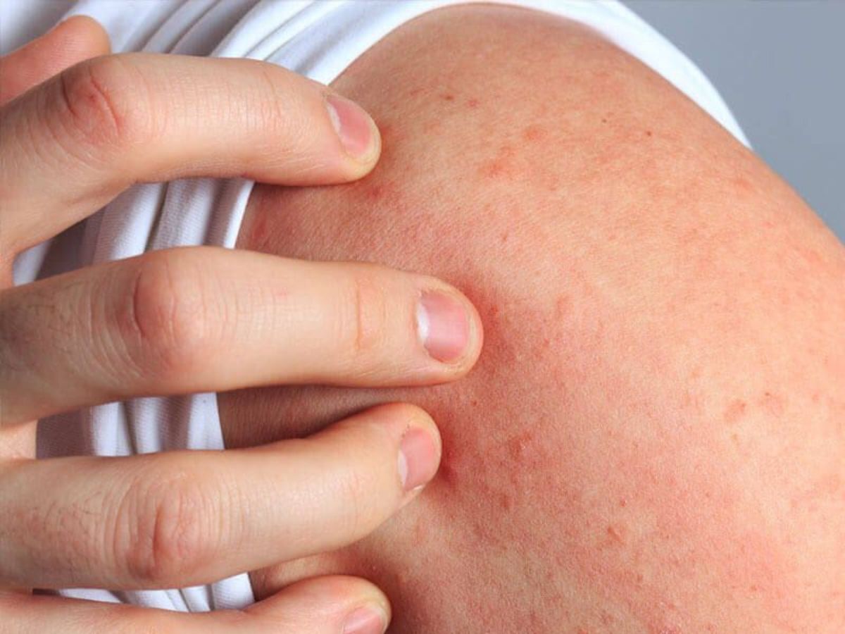 in-pics-from-dengue-to-skin-allergies-here-are-infections-and-allergies-that-spread-in-monsoon-season The wet and humid weather can cause skin problems and allergies (Image Credit- Pinterest) - Photo Gallery