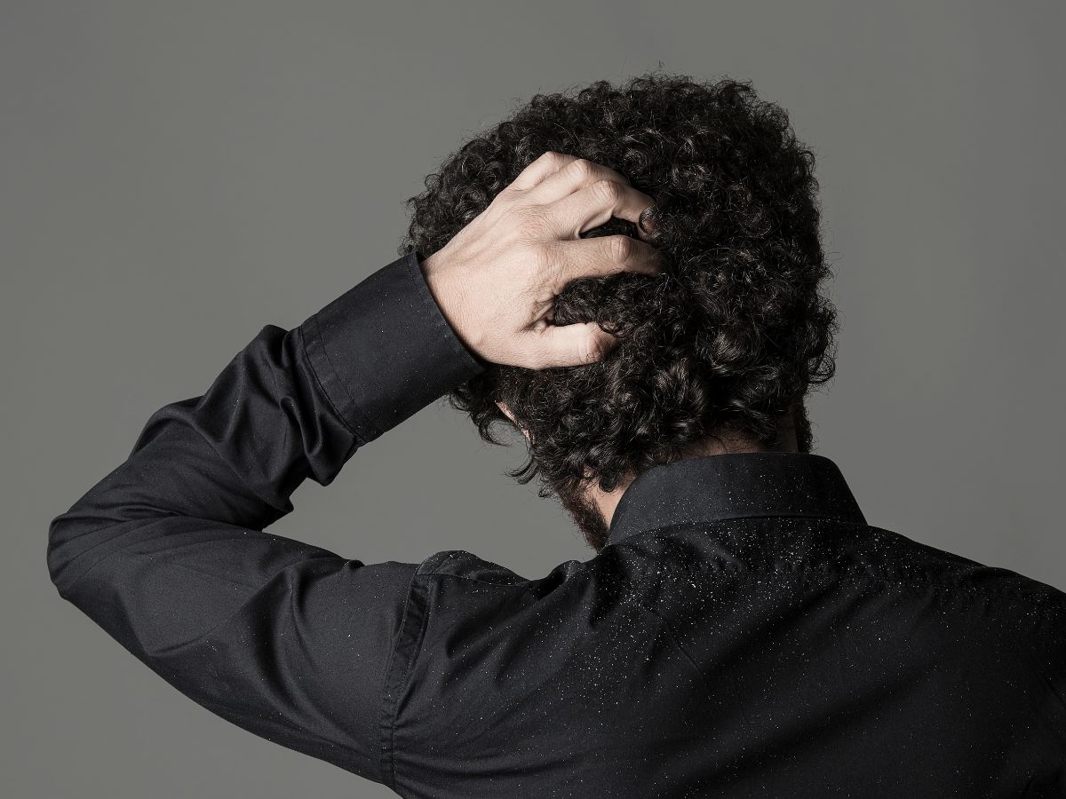 6-effective-ways-to-get-rid-of-beard-dandruff-naturally-and-permanently 6 Effective Ways to Get Rid of Beard Dandruff Naturally and Permanently - Photo Gallery