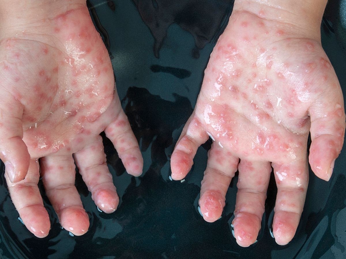 top-5-foods-to-eat-during-chickenpox-for-quick-healing-and-relief Top 5 Foods to Eat During Chickenpox for Quick Healing and Relief - Photo Gallery