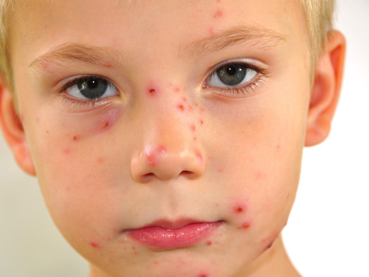 top-5-foods-to-eat-during-chickenpox-for-quick-healing-and-relief Top 5 Foods to Eat During Chickenpox for Quick Healing and Relief - Photo Gallery
