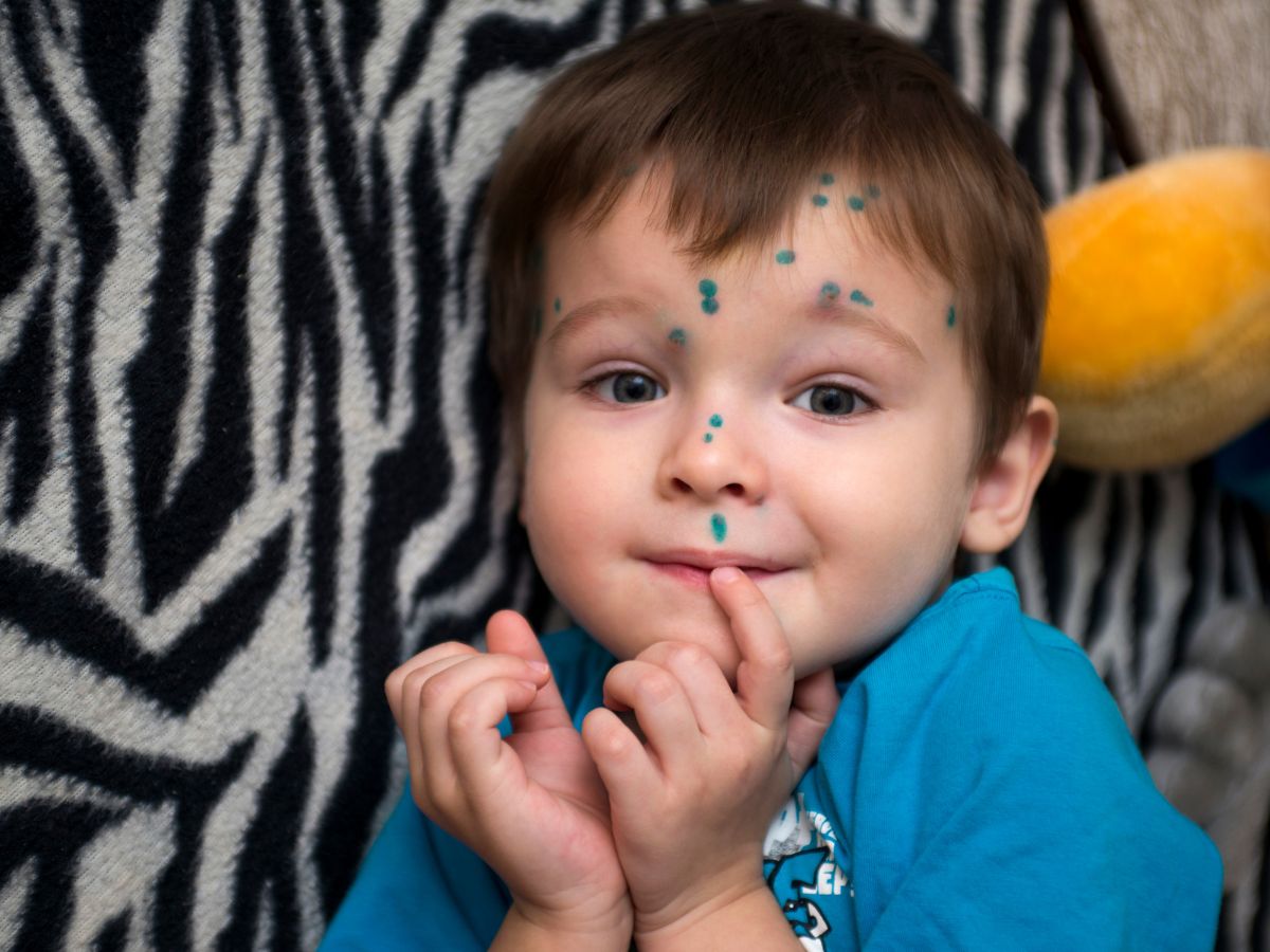 top-5-foods-to-eat-during-chickenpox-for-quick-healing-and-relief Top 5 Foods to Eat During Chickenpox for Quick Healing and Relief - Photo Gallery