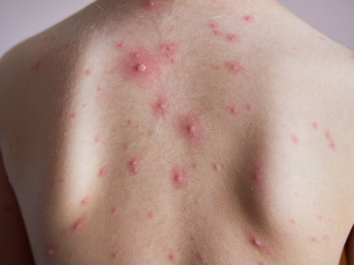 top-5-foods-to-eat-during-chickenpox-for-quick-healing-and-relief Top 5 Foods to Eat During Chickenpox for Quick Healing and Relief - Photo Gallery