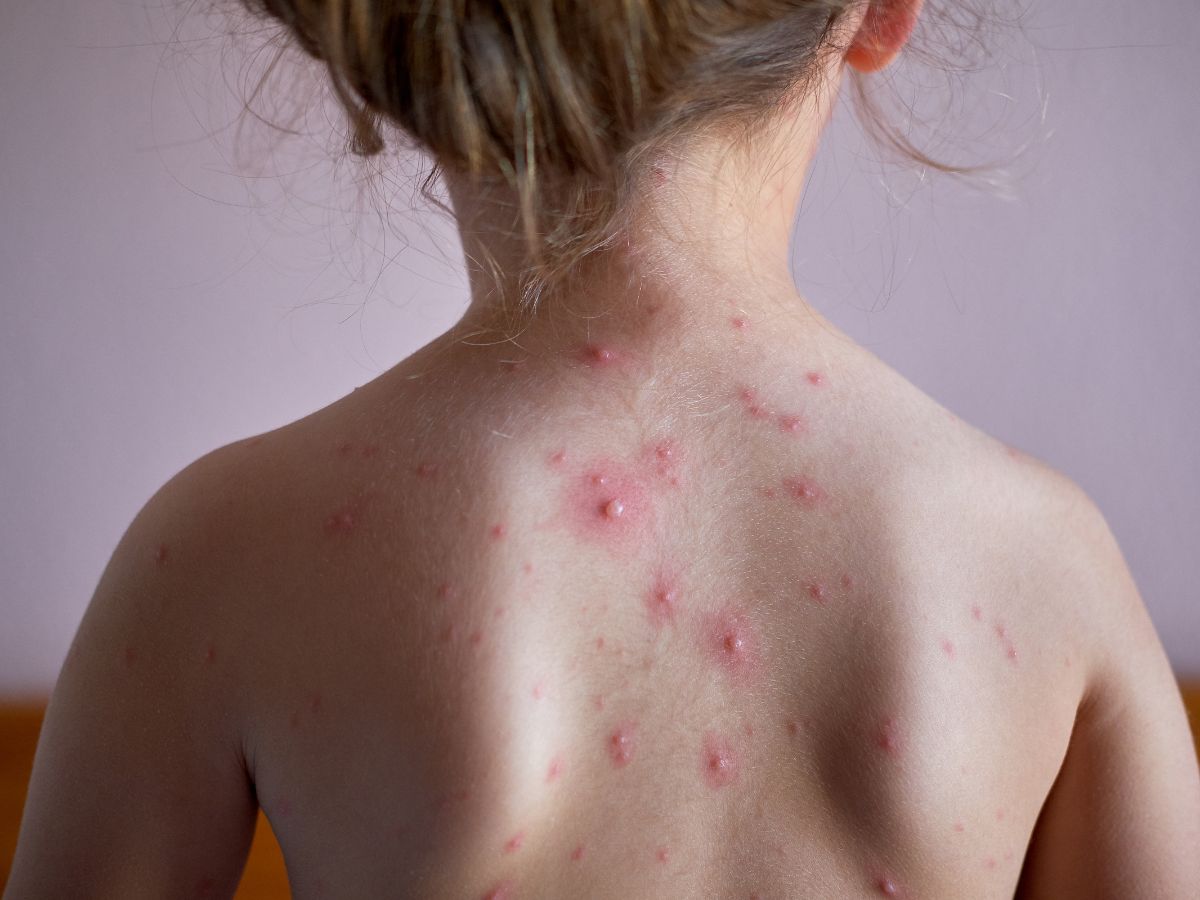 top-5-foods-to-eat-during-chickenpox-for-quick-healing-and-relief Top 5 Foods to Eat During Chickenpox for Quick Healing and Relief - Photo Gallery
