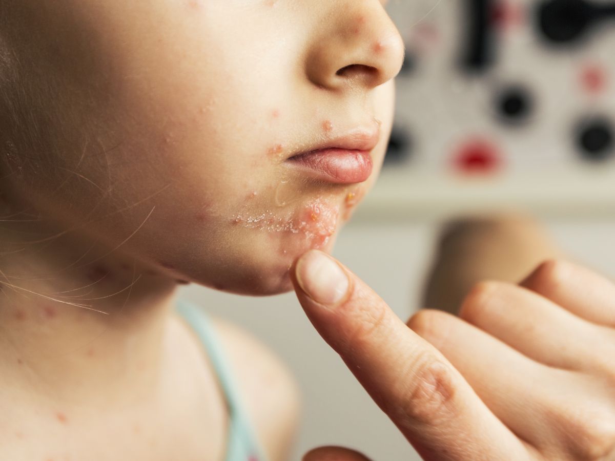 top-5-foods-to-eat-during-chickenpox-for-quick-healing-and-relief Top 5 Foods to Eat During Chickenpox for Quick Healing and Relief - Photo Gallery