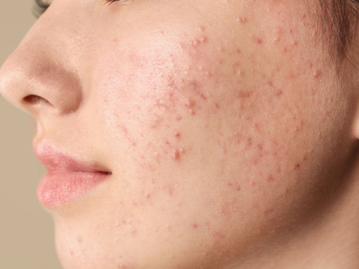 5 Skin Signs That Reveal Poor Gut Health - Photo Gallery