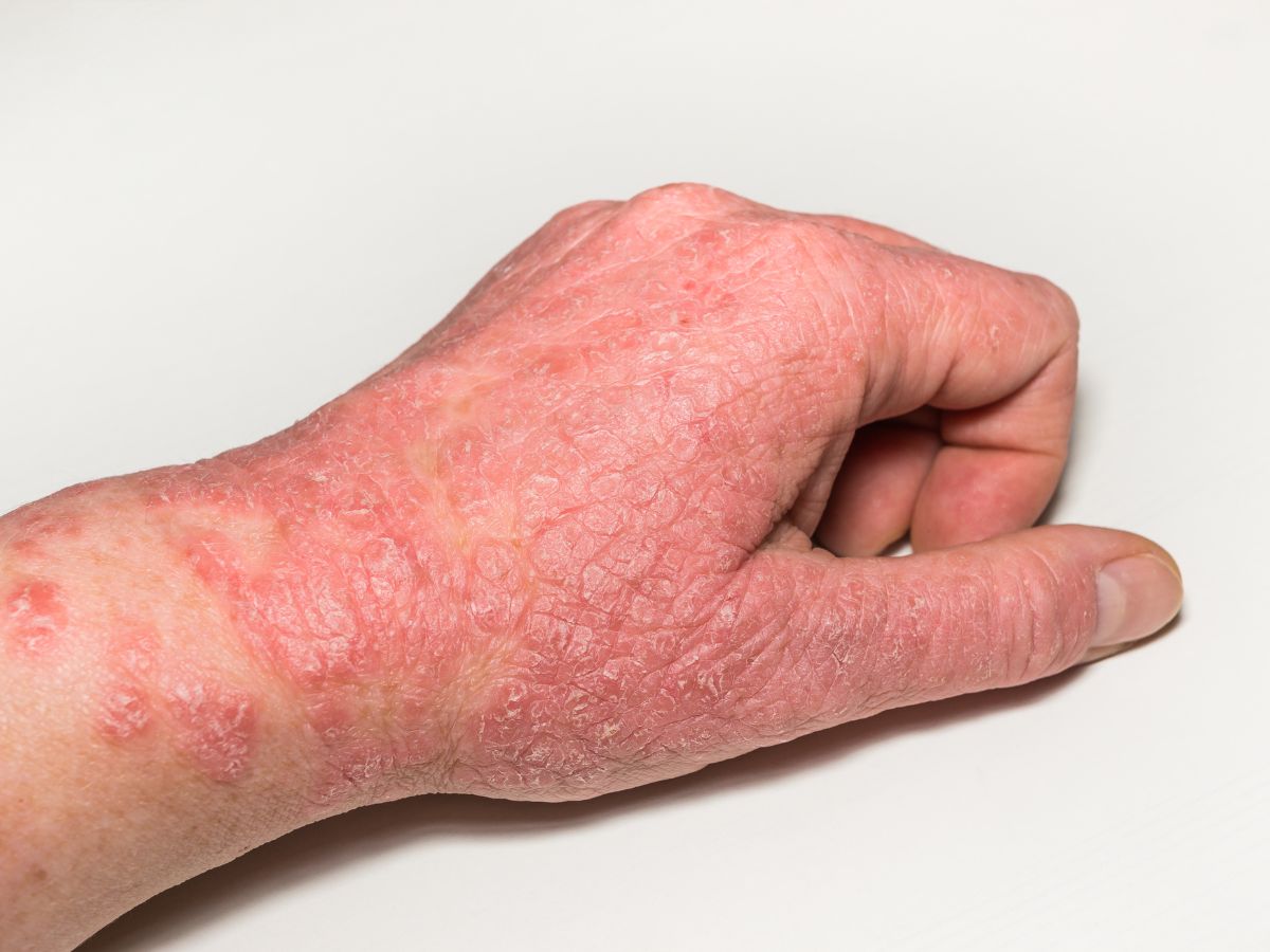 5 Skin Signs That Reveal Poor Gut Health - Photo Gallery