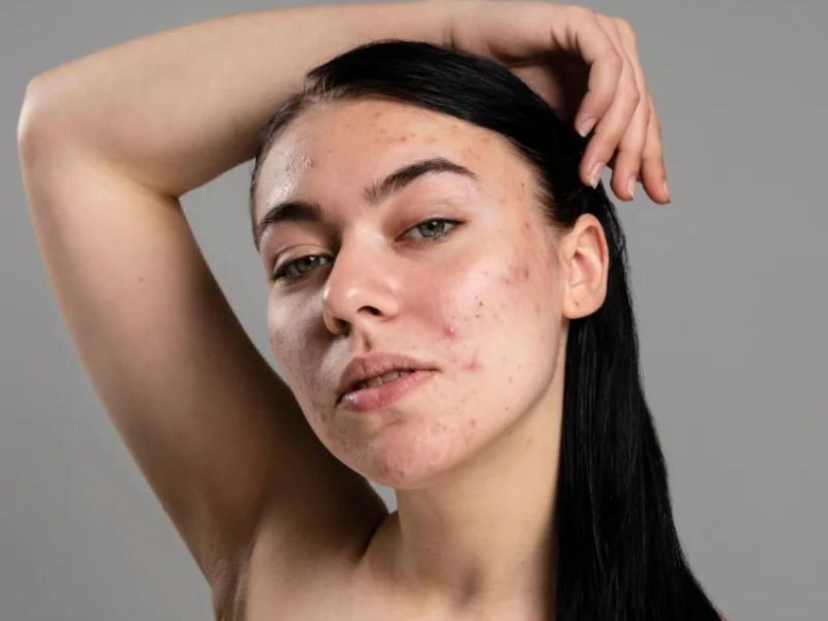 in-pics-struggling-to-remove-acne-here-are-few-effective-tips-to-have-a-acne-free-skin It is best to avoid touching the face as our hands carry dirt and can cause acne (Image Credit- Pinterest) - Photo Gallery
