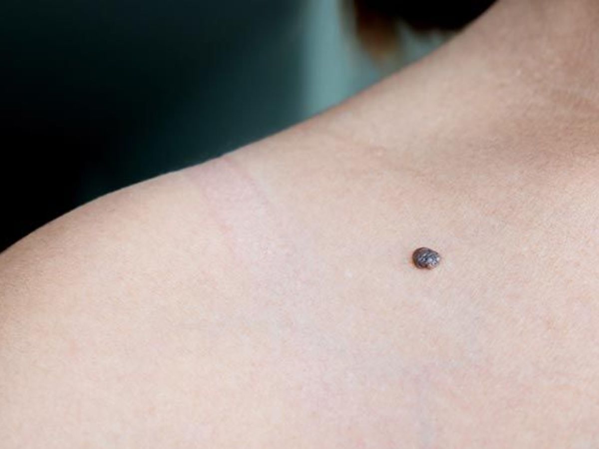 what-your-moles-say-about-you-exploring-the-hidden-meanings-of-beauty-marks-across-body What Your Moles Say About You? Exploring The Hidden Meanings Of Beauty Marks Across Body - Photo Gallery