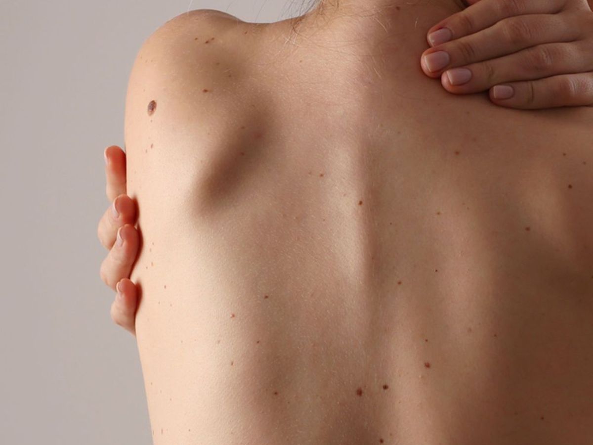 what-your-moles-say-about-you-exploring-the-hidden-meanings-of-beauty-marks-across-body What Your Moles Say About You? Exploring The Hidden Meanings Of Beauty Marks Across Body - Photo Gallery