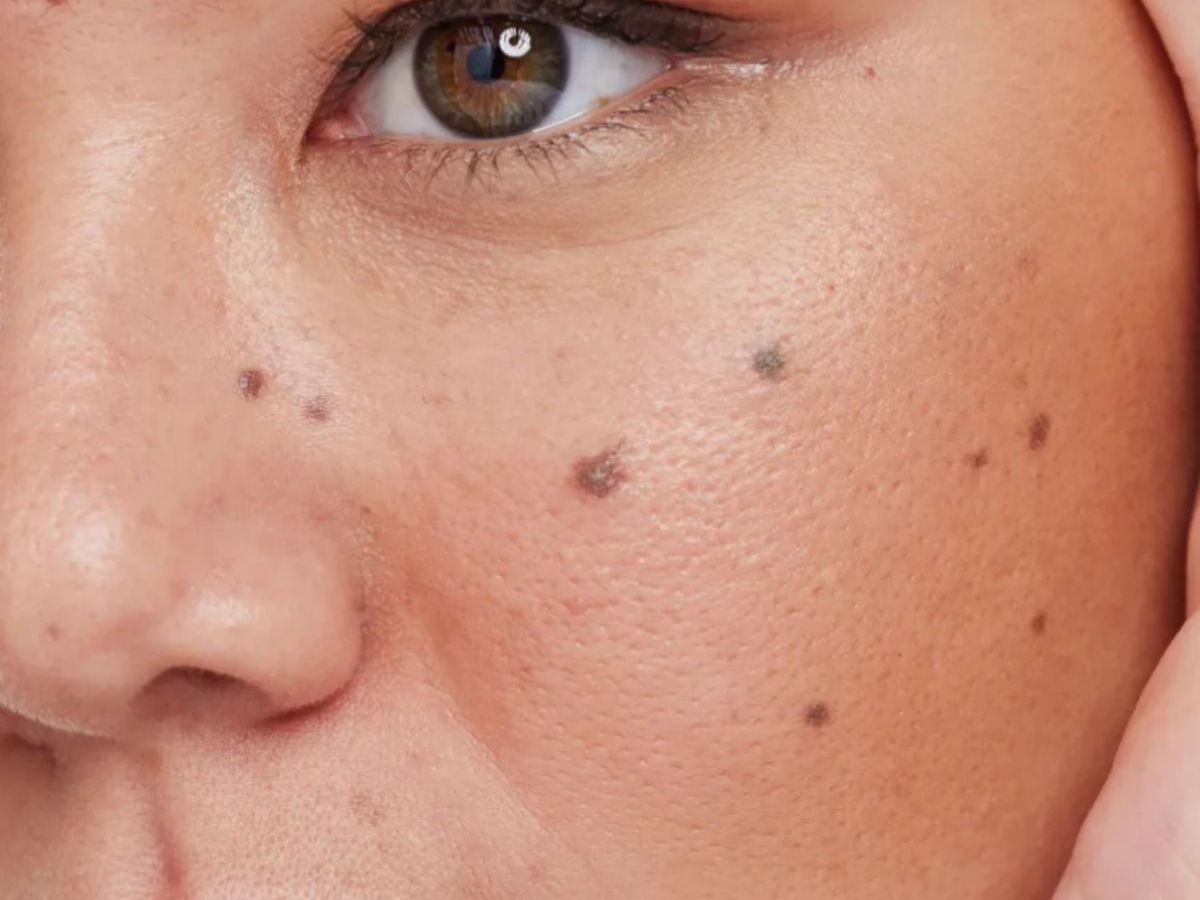 what-your-moles-say-about-you-exploring-the-hidden-meanings-of-beauty-marks-across-body What Your Moles Say About You? Exploring The Hidden Meanings Of Beauty Marks Across Body - Photo Gallery