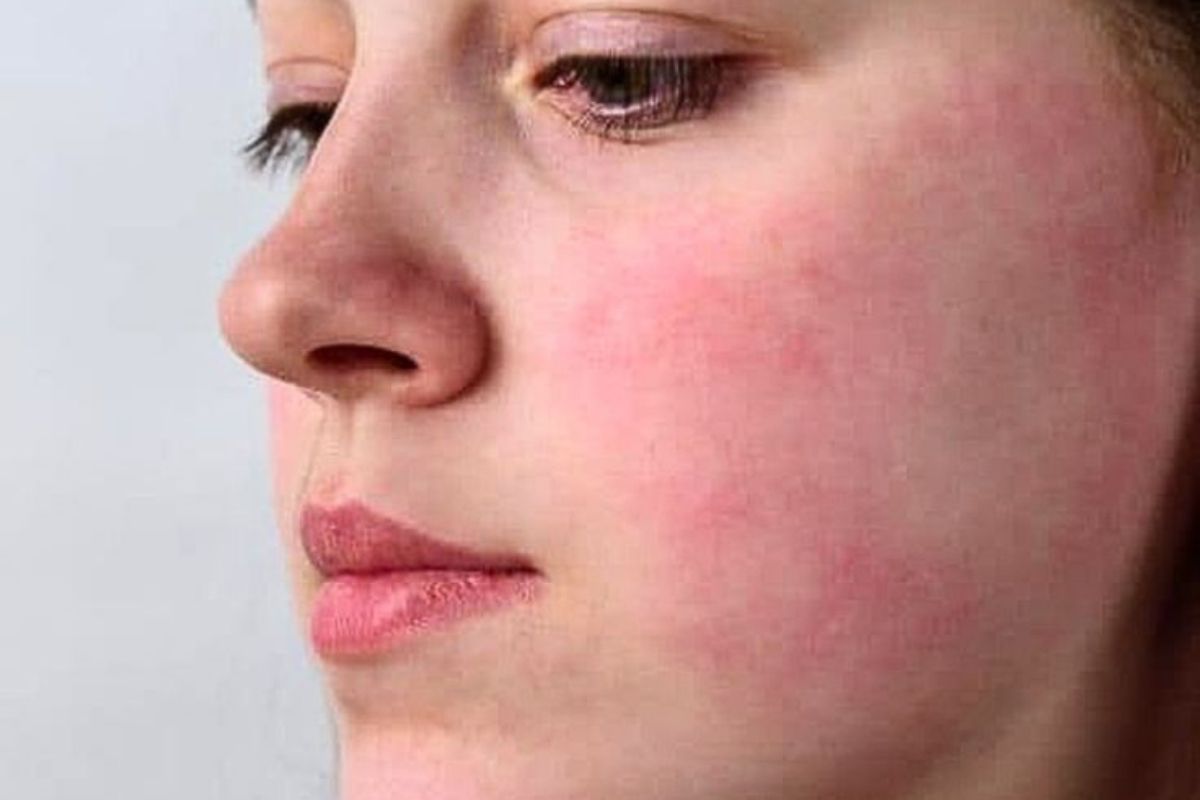 fatty-liver-clues-on-your-face-you-should-not-ignore-to-live-a-healthy-lifestyle Fatty Liver Clues On Your Face You Should Not Ignore - Photo Gallery