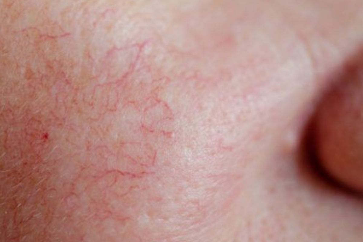 fatty-liver-clues-on-your-face-you-should-not-ignore-to-live-a-healthy-lifestyle Fatty Liver Clues On Your Face You Should Not Ignore - Photo Gallery