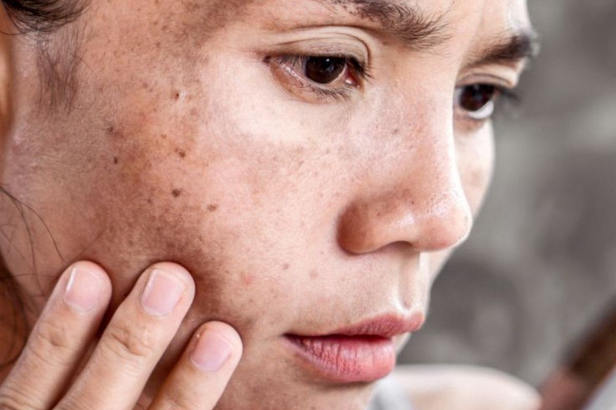 fatty-liver-clues-on-your-face-you-should-not-ignore-to-live-a-healthy-lifestyle Fatty Liver Clues On Your Face You Should Not Ignore - Photo Gallery
