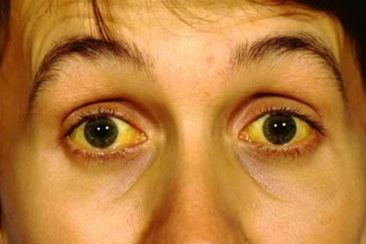 fatty-liver-clues-on-your-face-you-should-not-ignore-to-live-a-healthy-lifestyle Fatty Liver Clues On Your Face You Should Not Ignore - Photo Gallery
