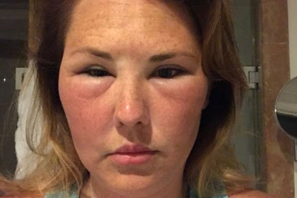 fatty-liver-clues-on-your-face-you-should-not-ignore-to-live-a-healthy-lifestyle Fatty Liver Clues On Your Face You Should Not Ignore - Photo Gallery