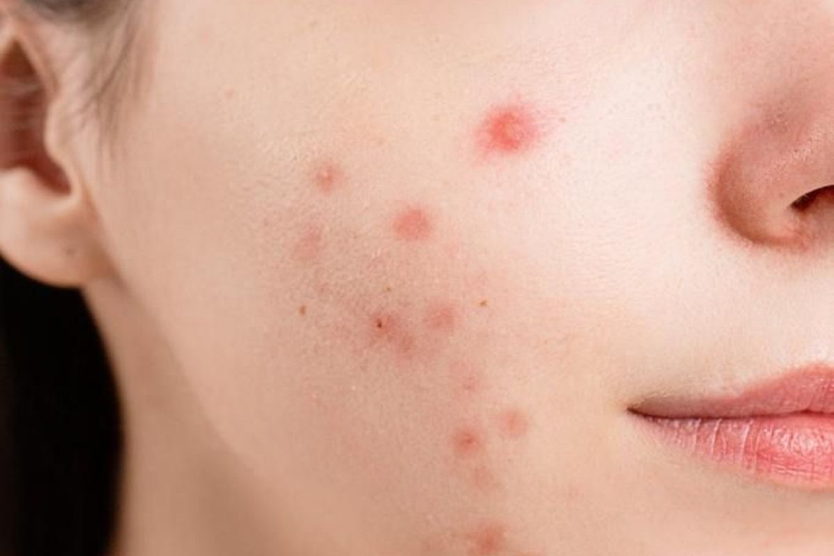 fatty-liver-clues-on-your-face-you-should-not-ignore-to-live-a-healthy-lifestyle Fatty Liver Clues On Your Face You Should Not Ignore - Photo Gallery