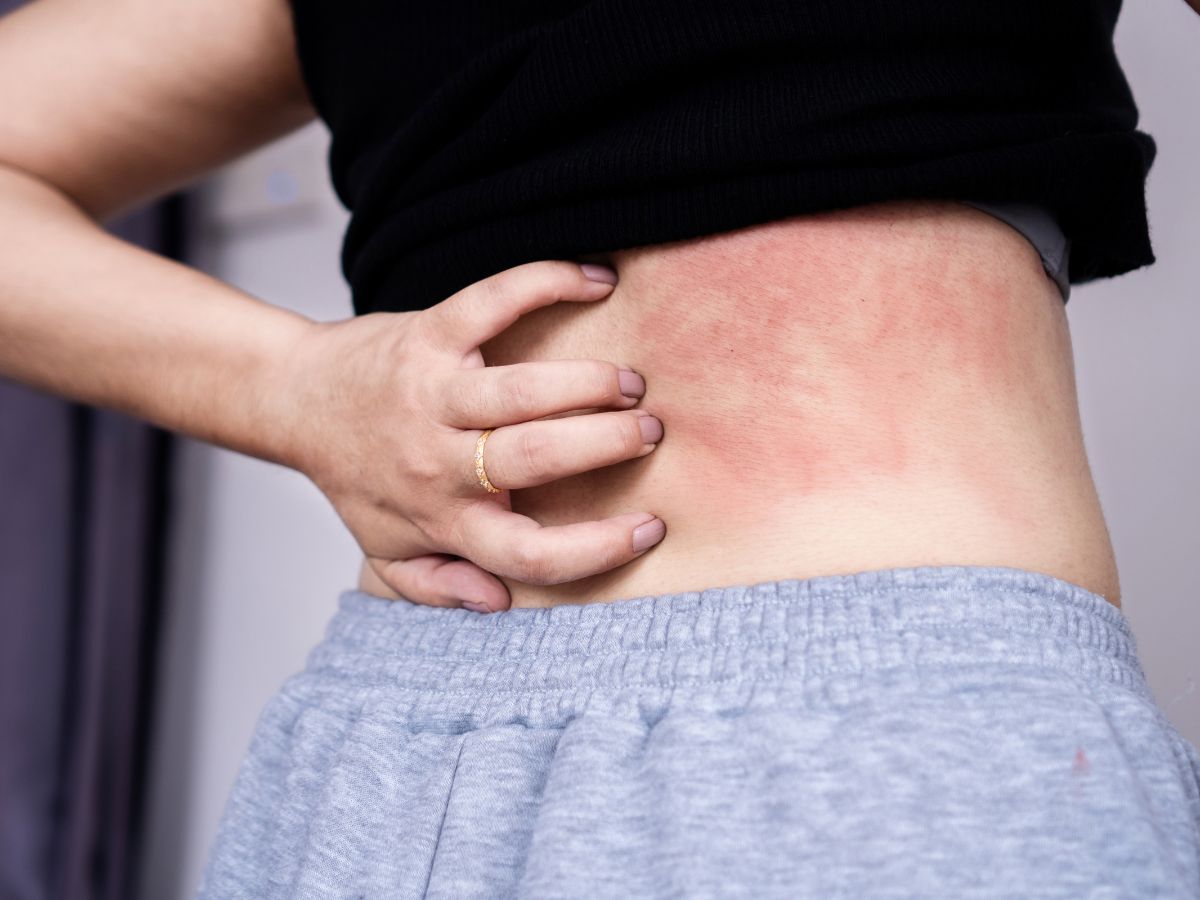 signs-and-symptoms-of-dengue-fever-early-warning-high-fever-joint-pain-rash-fatigue 6 Common Signs and Symptoms of Dengue You Shouldn’t Ignore - Photo Gallery