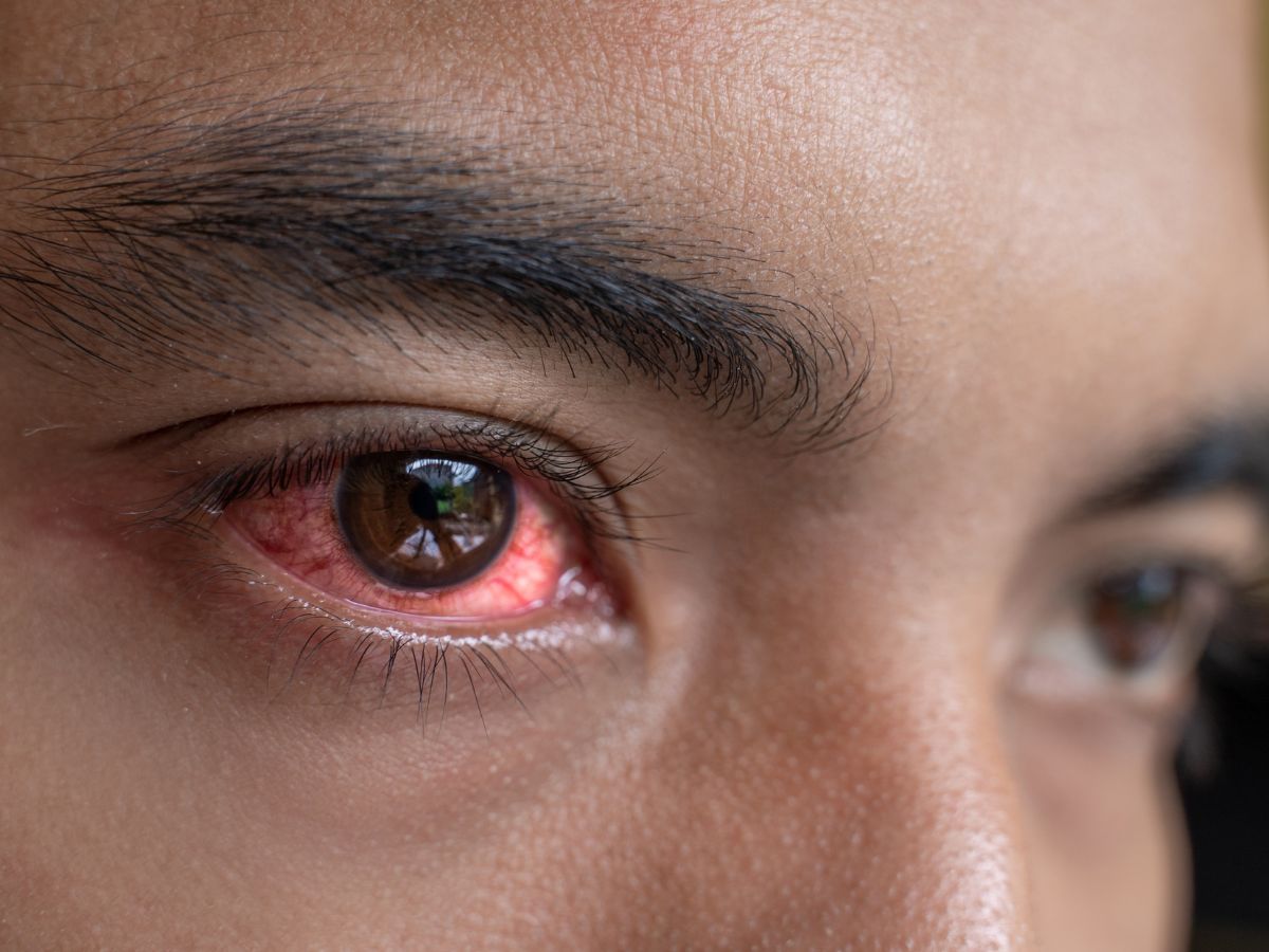 side-effects-of-wearing-contact-lenses-too-long-eye-infection-dryness-vision-problems What Happens When You Wear Lenses for 12 Hours? - Photo Gallery