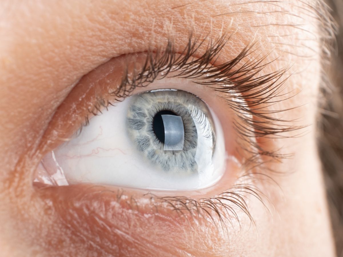 high-cholesterol-warning-signs-face-body-xanthomas-corneal-arcus-chest-pain-fatigue 6 Warning Signs of High Cholesterol That May Appear on Your Face and Body - Photo Gallery